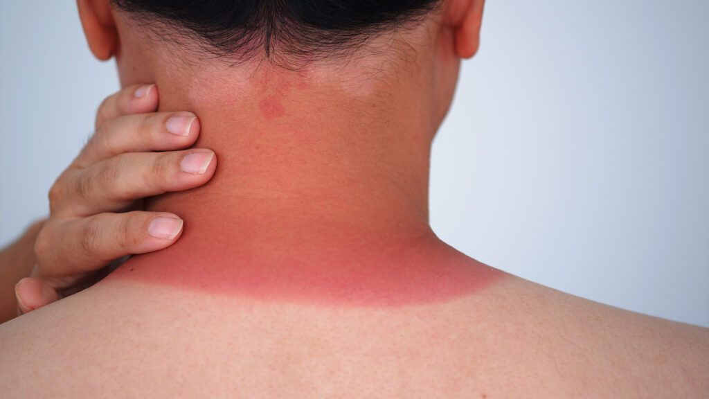 Person with sunburn on neck.